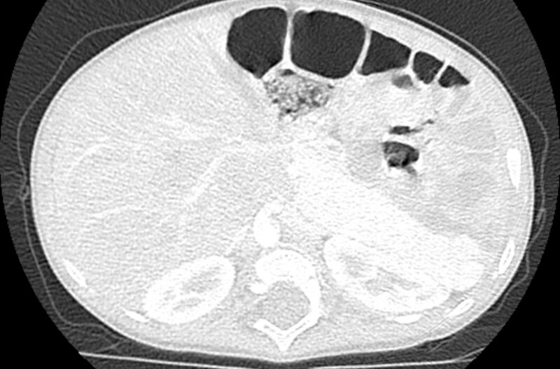 File:Asplenia syndrome (Radiopaedia 73083-83792 Axial lung window 80).jpg