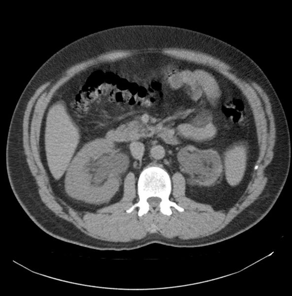 File:Atrophic kidney due to severe chronic obstructive hydronephrosis (Radiopaedia 40828-43474 Axial non-contrast 6).jpg