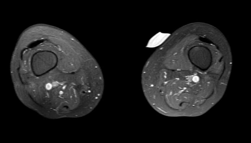 Atypical lipomatous tumor - thigh (Radiopaedia 68975-78734 Axial PD fat sat 22).jpg