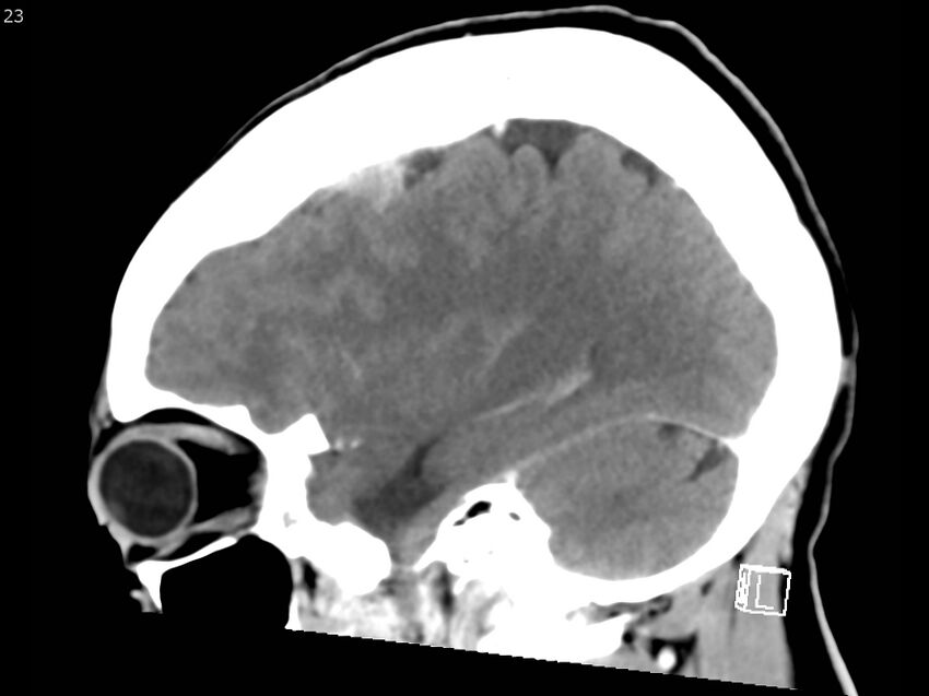 Atypical meningioma - intraosseous (Radiopaedia 64915-73867 F 22).jpg