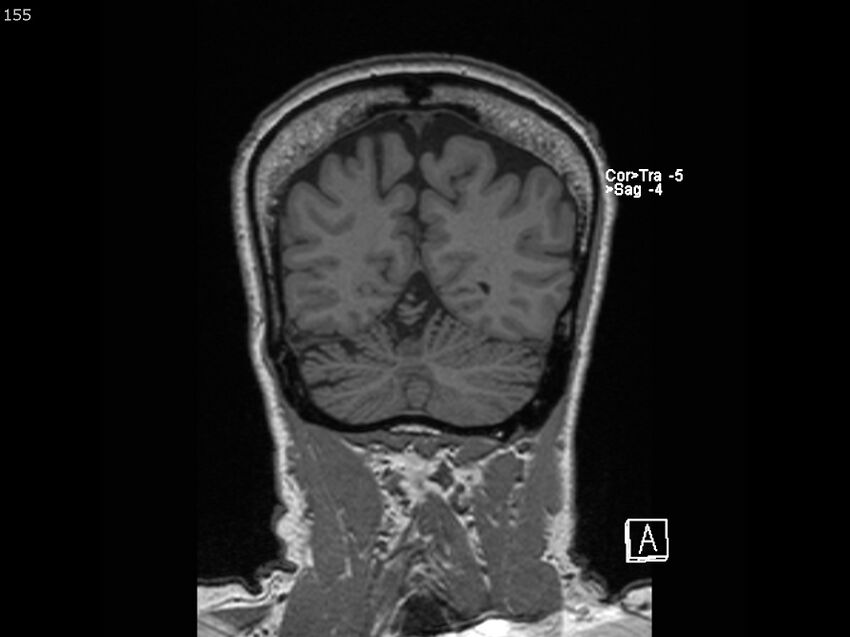 Atypical meningioma - intraosseous (Radiopaedia 64915-74572 Coronal T1 155).jpg