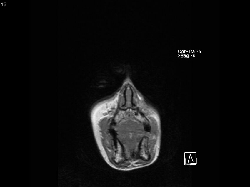 Atypical meningioma - intraosseous (Radiopaedia 64915-74572 Coronal T1 18).jpg