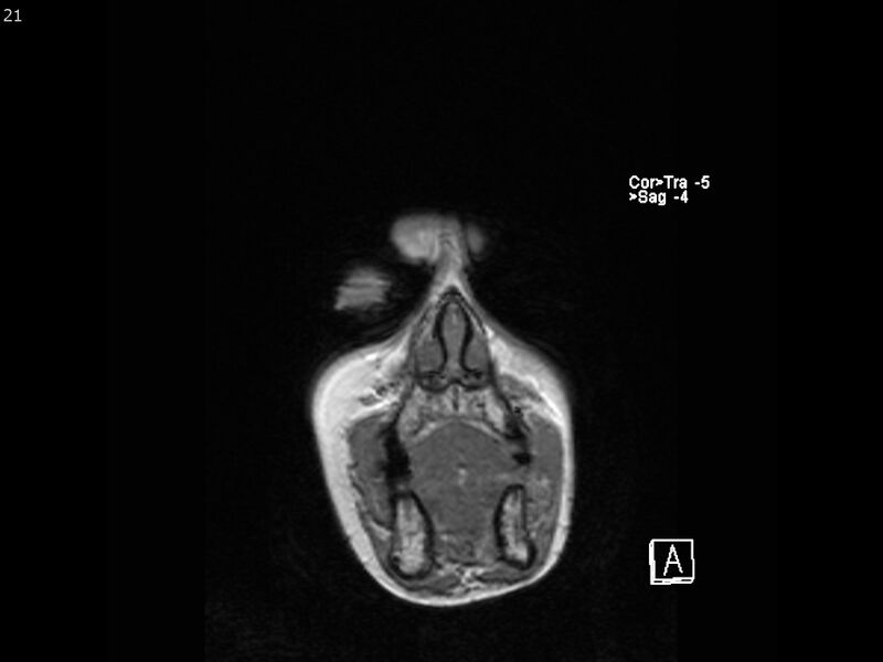 File:Atypical meningioma - intraosseous (Radiopaedia 64915-74572 Coronal T1 21).jpg