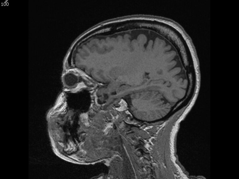File:Atypical meningioma - intraosseous (Radiopaedia 64915-74572 Sagittal T1 100).jpg