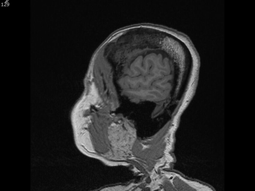 Atypical meningioma - intraosseous (Radiopaedia 64915-74572 Sagittal T1 129).jpg