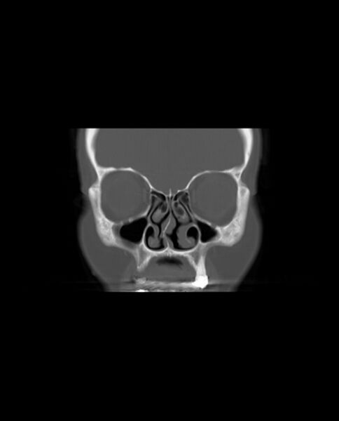 File:Automastoidectomy with labyrinthine fistula (Radiopaedia 84143-99411 Coronal non-contrast 23).jpg