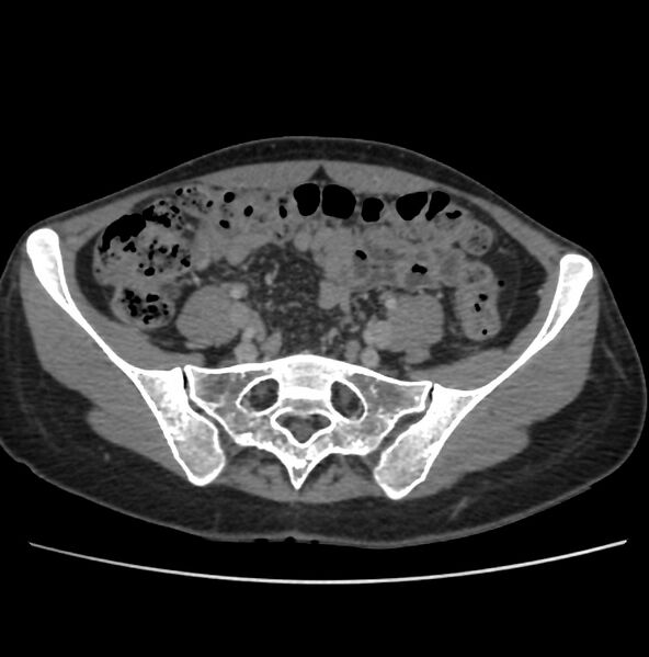 File:Autosomal dominant polycystic kidney disease - early onset (Radiopaedia 40734-43387 A 63).jpg