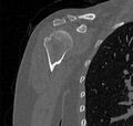 Avulsion fracture - greater tuberosity of humerus (Radiopaedia 71216-81514 Coronal bone window 20).jpg