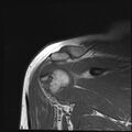 Avulsion fracture - greater tuberosity of humerus (Radiopaedia 71216-81515 Coronal T1 7).jpg