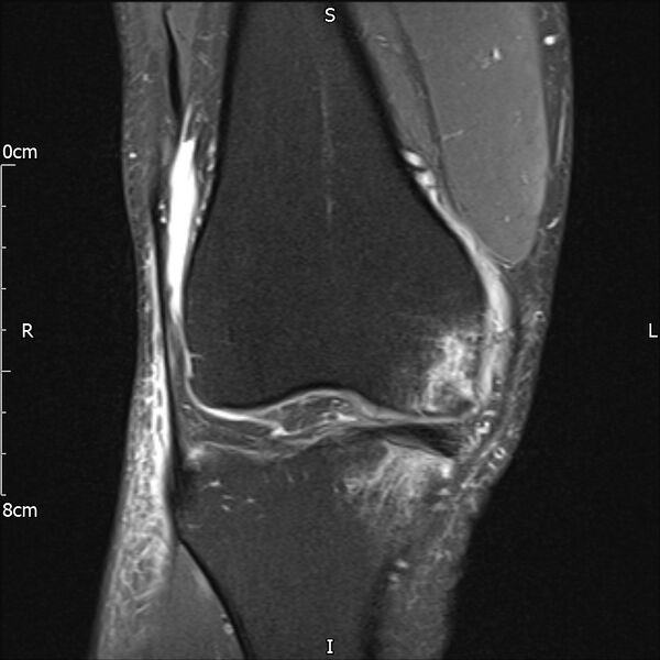 File:Avulsion fracture of the fibular head (Radiopaedia 74804-85808 Coronal PD fat sat 15).jpg