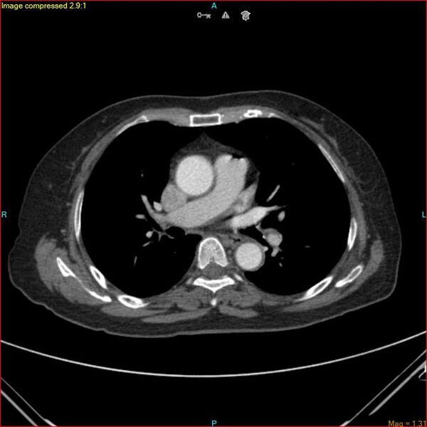 File:Azygos vein aneurysm (Radiopaedia 77824-90130 B 29).jpg