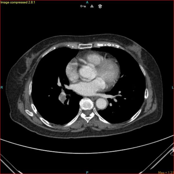 File:Azygos vein aneurysm (Radiopaedia 77824-90130 B 34).jpg
