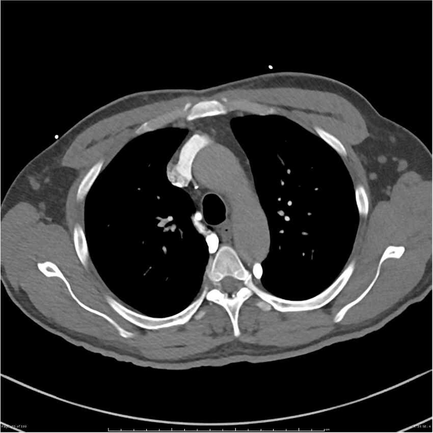 Azygos venous system anatomy (CT pulmonary angiography) (Radiopaedia 25928-26077 Axial C+ CTPA 25).jpg