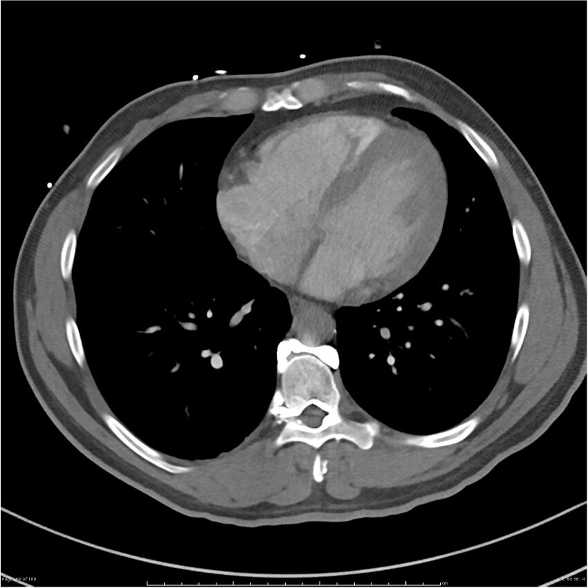 Azygos venous system anatomy (CT pulmonary angiography) (Radiopaedia 25928-26077 Axial C+ CTPA 60).jpg