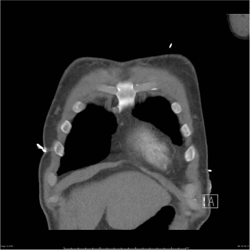Azygos venous system anatomy (CT pulmonary angiography) (Radiopaedia 25928-26077 Coronal C+ CTPA 9).jpg
