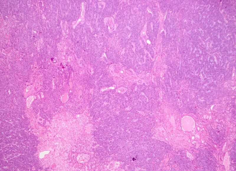 File:Basal cell adenoma - salivary gland (Radiopaedia 43989-47511 C 1).jpg