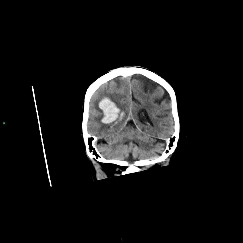 Basal ganglia hemorrhage (Radiopaedia 58350-65473 Coronal non-contrast 21).jpg