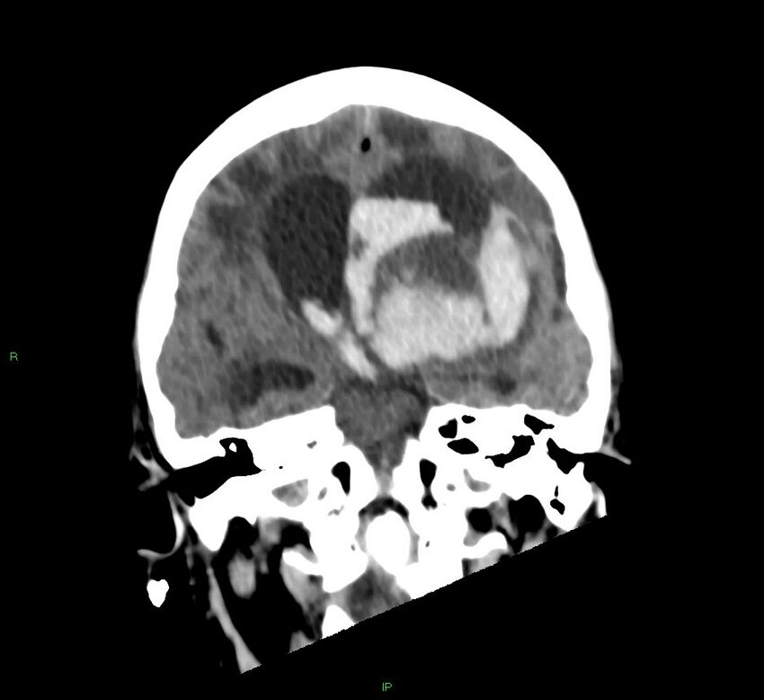 Basal ganglia hemorrhage (Radiopaedia 58766-65988 Coronal non-contrast 37).jpg