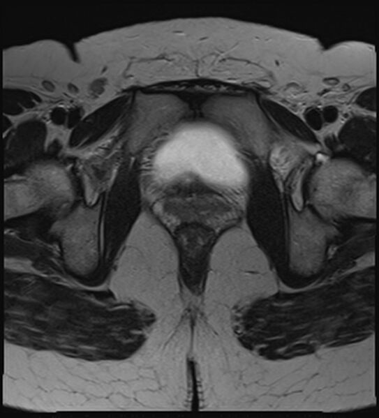 File:Bicornuate, unicollis uterus (Radiopaedia 79468-92593 Axial T2 21).jpg