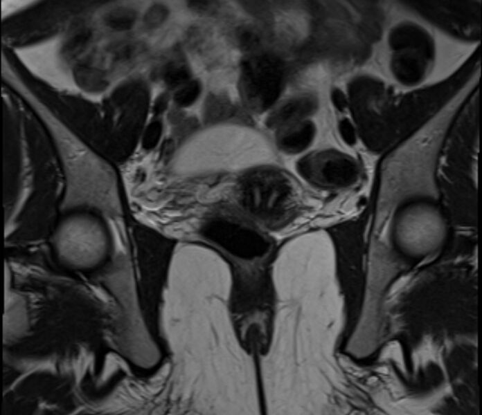 File:Bicornuate uterus (Radiopaedia 71214-81511 Coronal T2 18).jpg