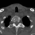 Bilateral C6-7 locked facet dislocation (Radiopaedia 28506-28748 Axial bone window 42).jpeg