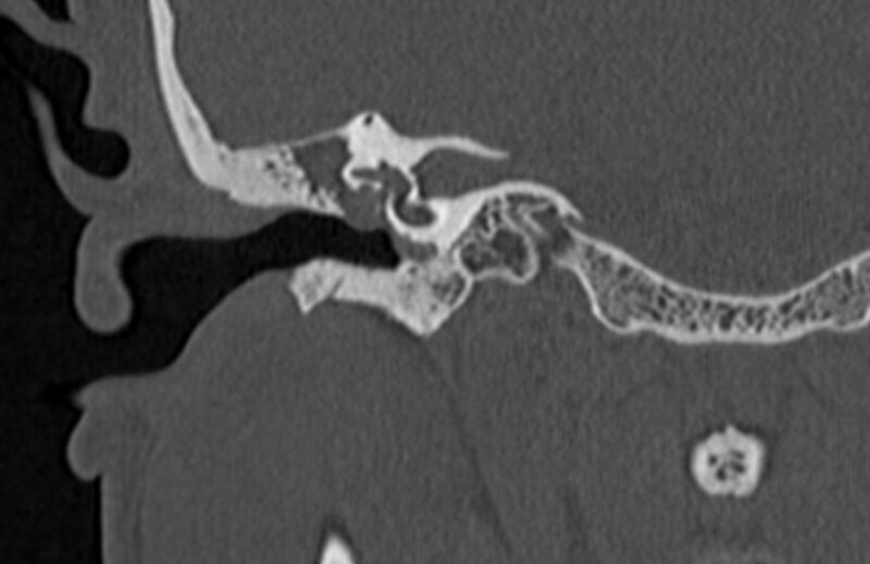 File:Bilateral cholesteatoma (Radiopaedia 54898-61172 Coronal bone window 36).jpg