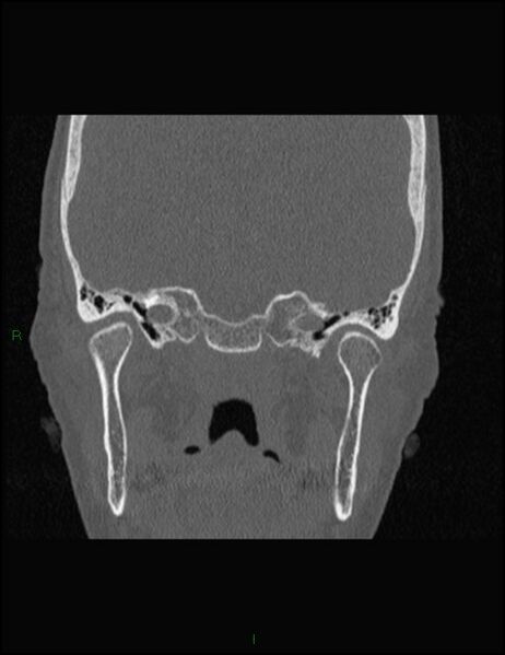 File:Bilateral frontal mucoceles (Radiopaedia 82352-96454 Coronal 282).jpg