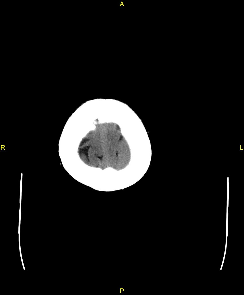 Bilateral isodense subdural hematomas (Radiopaedia 88621-105325 Axial non-contrast 104).jpg