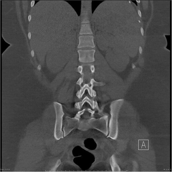 File:Bilateral lumbar ribs (Radiopaedia 25862-26010 Coronal bone window 13).jpg
