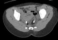 Bilateral mature cystic ovarian teratoma (Radiopaedia 88821-105592 Axial non-contrast 27).jpg