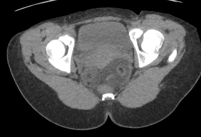 File:Bilateral mature cystic ovarian teratoma (Radiopaedia 88821-105592 Axial non-contrast 42).jpg