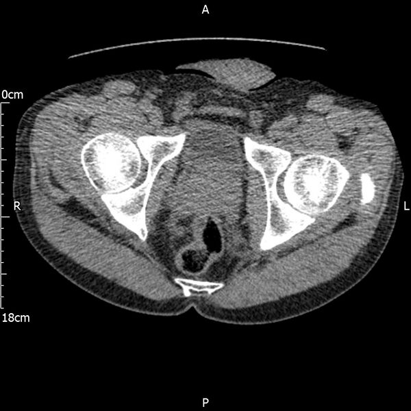 File:Bilateral medullary nephrocalcinosis with ureteric calculi (Radiopaedia 71269-81569 Axial non-contrast 129).jpg