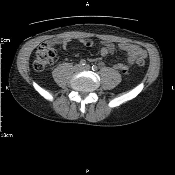 File:Bilateral medullary nephrocalcinosis with ureteric calculi (Radiopaedia 71269-81569 Axial non-contrast 82).jpg