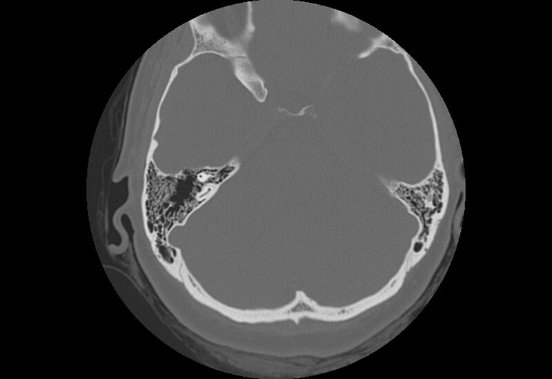File:Bilateral otospongiosis (Radiopaedia 35447-36940 Axial bone window 43).jpg