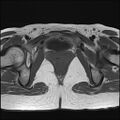 Bilateral ovarian endometriomas (Radiopaedia 87085-103347 Axial T1 19).jpg