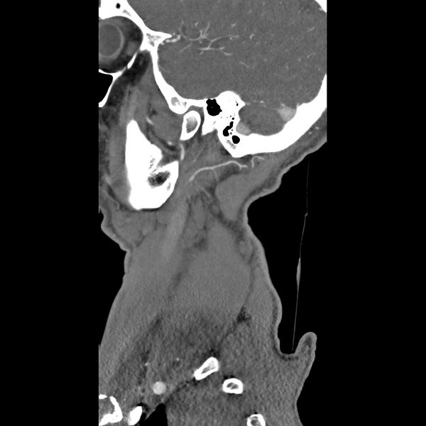 File:Bilateral perched facets with cord injury (Radiopaedia 45587-49713 B 1).jpg