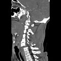 Bilateral perched facets with cord injury (Radiopaedia 45587-49713 B 30).jpg