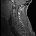 Bilateral perched facets with cord injury (Radiopaedia 45587-49714 Sagittal T1 9).jpg