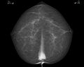 Bilateral sternalis muscle at mammography (Radiopaedia 24366-24656 A 1).jpg