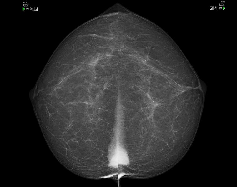 File:Bilateral sternalis muscle at mammography (Radiopaedia 24366-24656 A 1).jpg