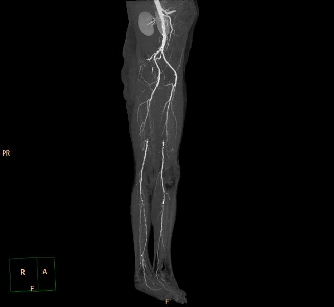 File:Bilateral superficial femoral arterial occlusion (Radiopaedia 25682-25857 3D MIP 5).jpg