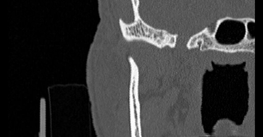 Bilateral temporal bone fractures (Radiopaedia 29482-29970 Coronal non-contrast 20).jpg