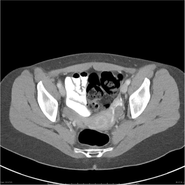 File:Bilateral ureteritis and cystitis (Radiopaedia 25340-25594 A 67).jpg