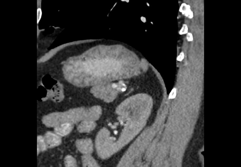 File:Bilateral urolithiasis with incidentally detected splenic artery aneurysm and left inferior vena cava (Radiopaedia 44467-48127 Ob. Sag. C+ Art. 18).jpg