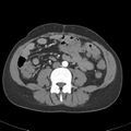 Biliary necrosis - liver transplant (Radiopaedia 21876-21845 A 38).jpg