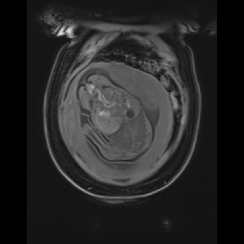 Bilobed placenta accreta (Radiopaedia 69648-79591 Coronal T1 vibe 35).jpg