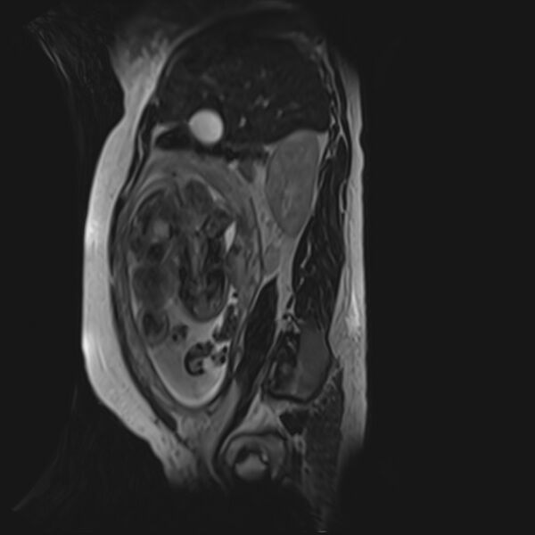File:Bilobed placenta accreta (Radiopaedia 69648-79591 G 43).jpg