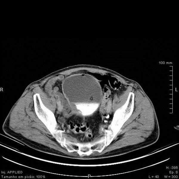 File:Bladder squamous cell carcinoma (Radiopaedia 14130-13984 C 5).jpg