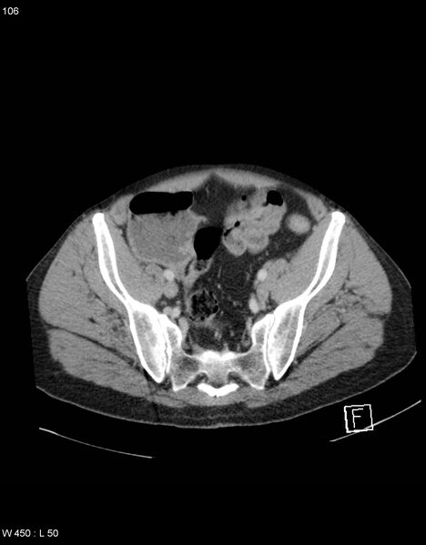 File:Boerhaave syndrome with tension pneumothorax (Radiopaedia 56794-63603 A 53).jpg