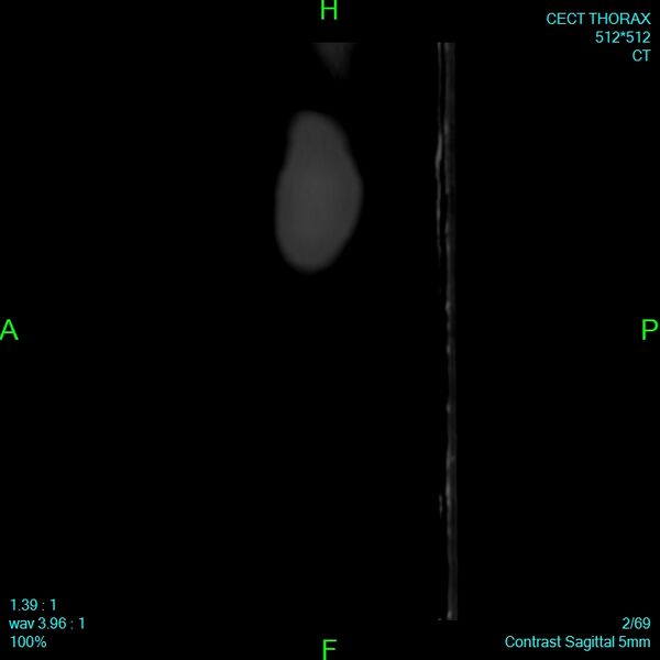 File:Bone metastases from lung carcinoma (Radiopaedia 54703-60937 Sagittal bone window 2).jpg